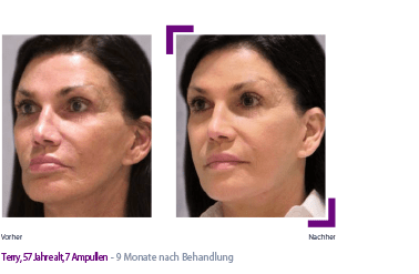 Sculptra poly-L-lactic acid 2 vials