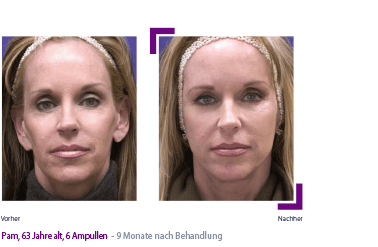 Sculptra poly-L-lactic acid 2 vials