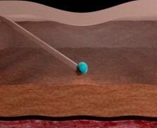 Perfectha Derm (1x1.0ml)