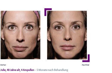 Sculptra poly-L-lactic acid 2 vials