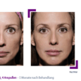 Sculptra poly-L-lactic acid 2 vials