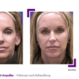 Sculptra poly-L-lactic acid 2 vials